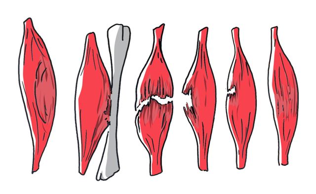 Déchirure musculaire rupture lésions